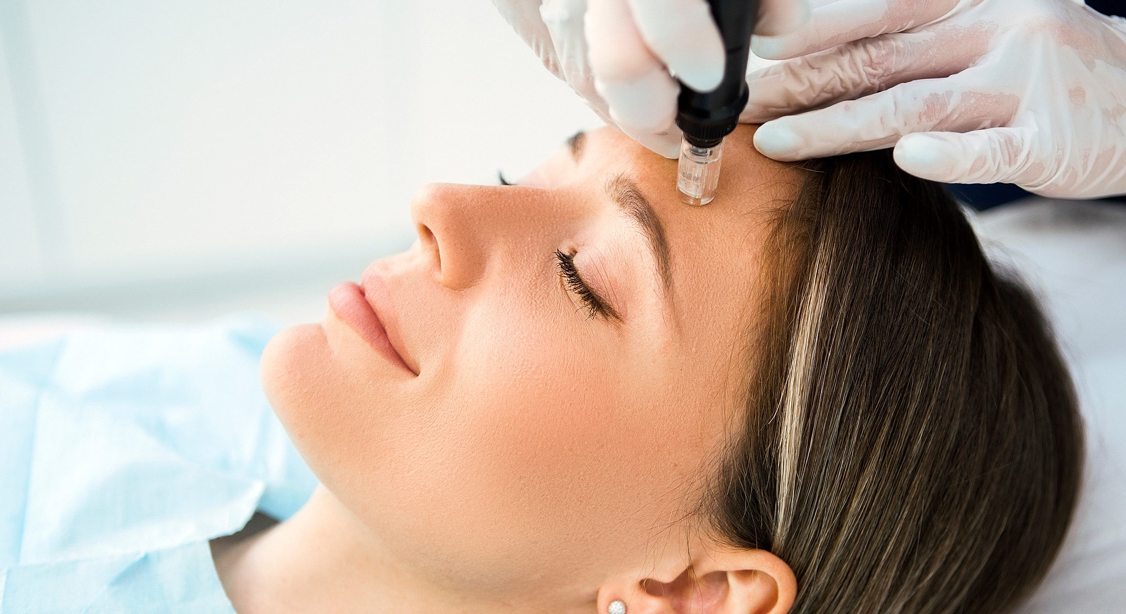 Microneedling treatment on a woman's forehead.