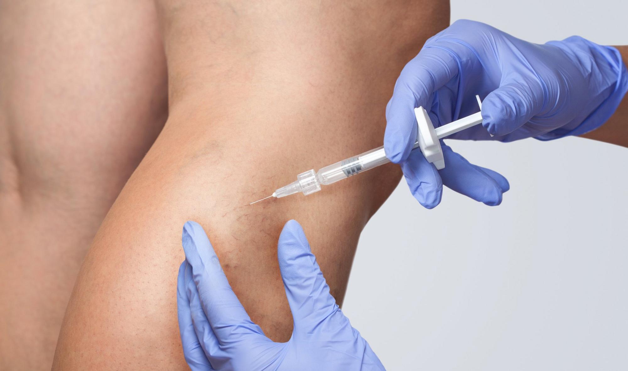 Introduction to Sclerotherapy Course